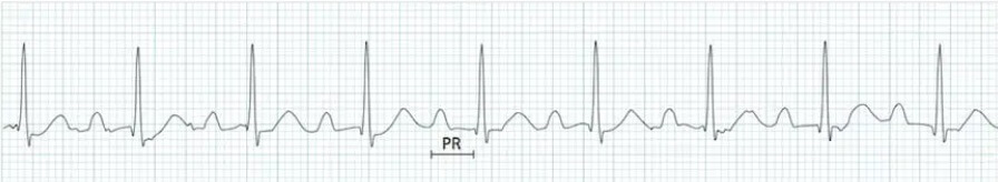 1도 방실차단 심전도 사진