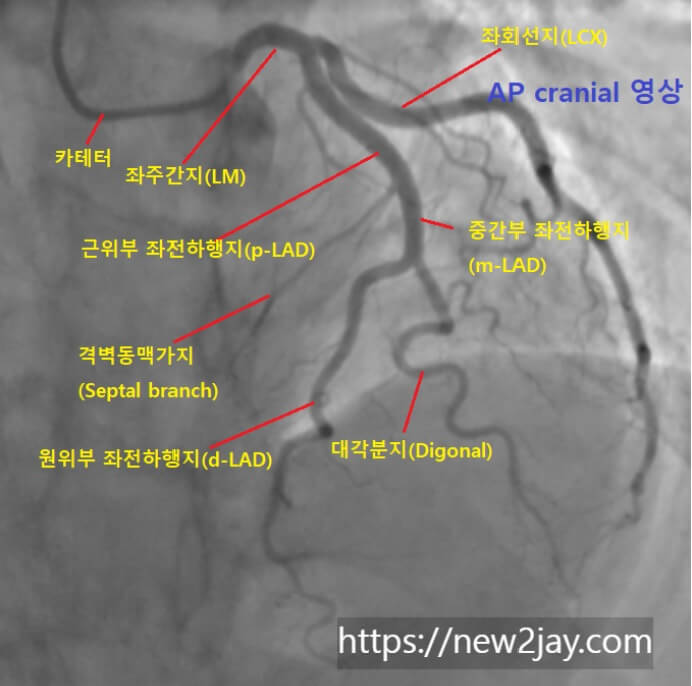 관상동맥조영술에서 좌전하행지동맥(LAD)을 촬영한 영상입니다. 