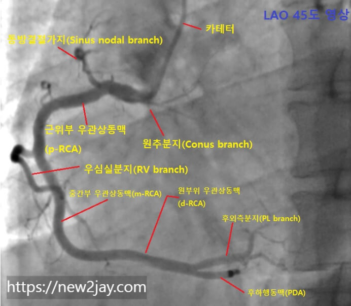 관상동맥조영술에서 우관상동맥(RCA)을 촬영한 영상입니다.