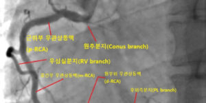 관상동맥조영술을 통한 관상동맥 혈관 종류