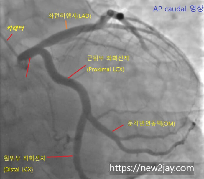 관상동맥조영술에서 좌회선지동맥(LCX)을 촬영한 영상입니다. 