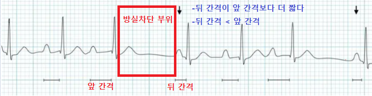 2도 1형 방실결절 심전도 사진으로 방실차단 부위의 뒤 간격이 앞 간격보다 짧으면 2도 1형 방실결절이라는 설명을 나타낸 사진