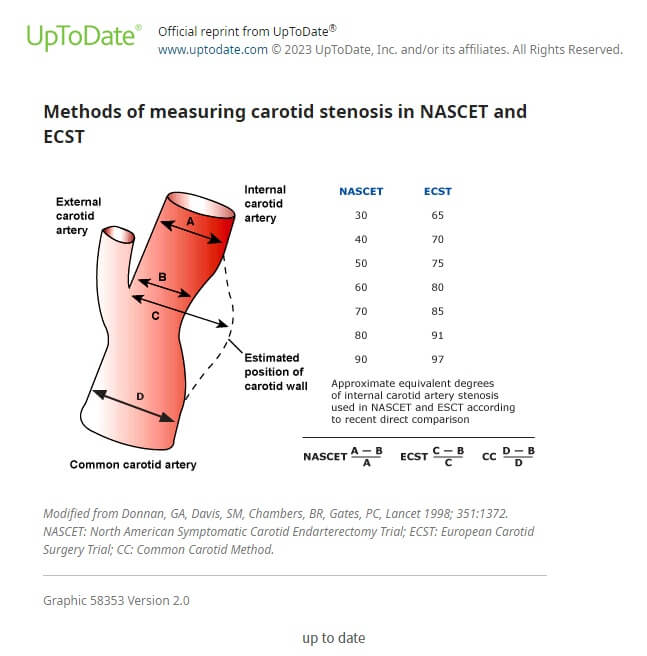 'UP to date' 홈페이지에서 발췌한 이미지로 경동맥 협착증을 평가하는 3가지 방법의 공식이 그림으로 설명되어 있습니다.