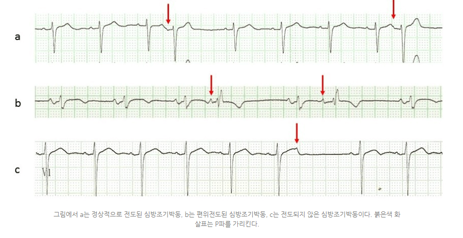 심방조기수축 시 3가지 심전도의 모습