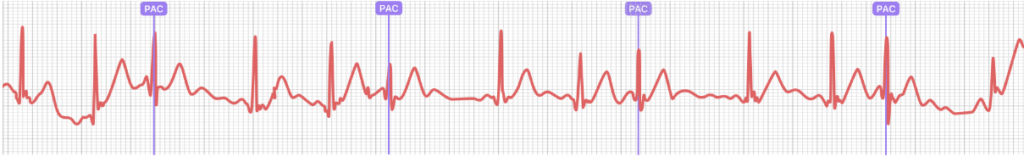 정상리듬과 PAC가 2:1로 나오는 패턴의 심전도 모습