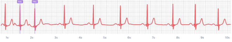  PAC가 연속 2개 나온 심전도의 모습