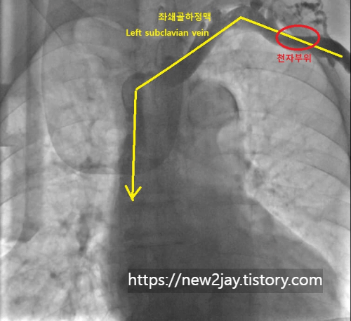 좌쇄골하정맥을 조영제로 조영한 영상이 담긴 사진