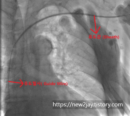 유도관이 삽입되고 유도철사가 심장아까이 들어간 x-ray 영상의 사진