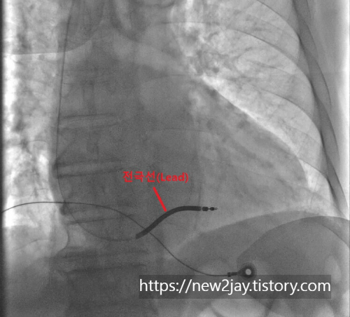 전극선이 우심실에 들어간 사진