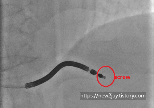 screw를 통해 전극선을 심장근육에 고정하는 모습의 사진