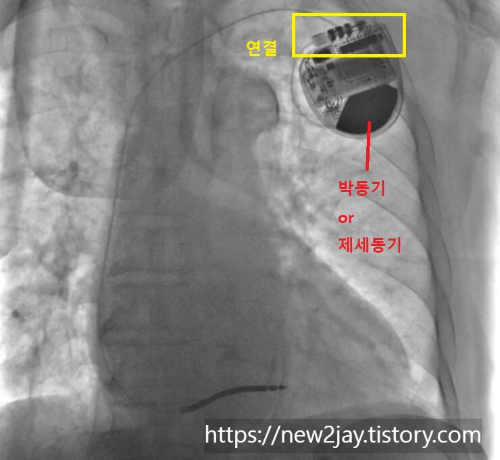 인공심장박동기 시술 후 마지막 확인 영상이 담진 사진