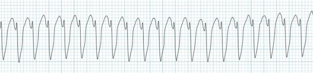 Monomorphic VT 심전도 소견 사진