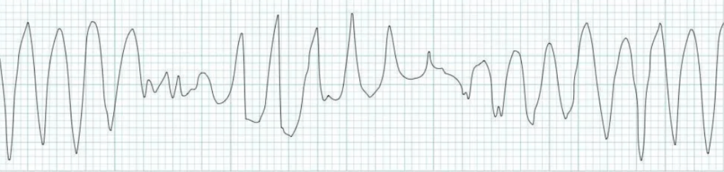 Polymorphic VT의 심전도 소견 사진