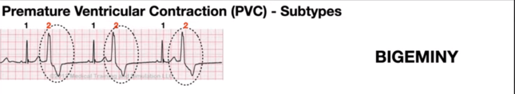 정상리듬과 PVC가 1:1로 나오는 패턴의 PVC Bigeminy 심전도 사진