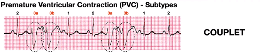 Ventricular couplet 소견의 심전도 사진