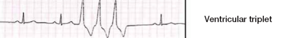 Ventricular Triplet 소견의 심전도 사진