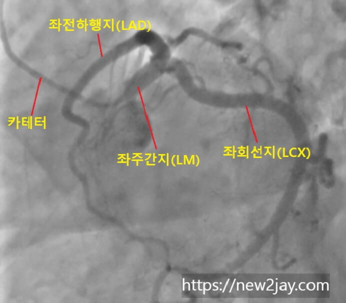 관상동맥조영술에서 좌회선지동맥(LCX)을 촬영한 영상입니다. 