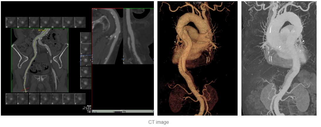 흉부대동맥 질환 환자 CT 영상