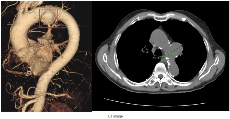 흉부대동맥 질환 환자 CT 영상