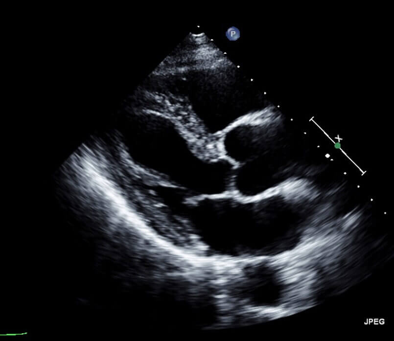 심장초음파 이미지